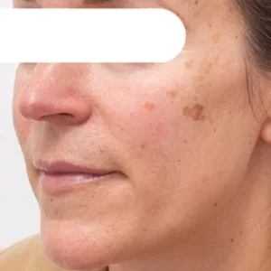 AEXZR® Herbal Flecken Peel-Off Gesichtsmaske | BEGRENZTES RABATTANGEBOT✨