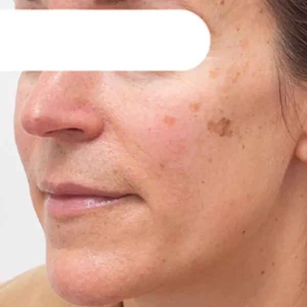 AEXZR® Herbal Flecken Peel-Off Gesichtsmaske | BEGRENZTES RABATTANGEBOT✨