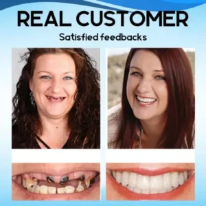 AEXZR™ SnapOn Silicone Veneers