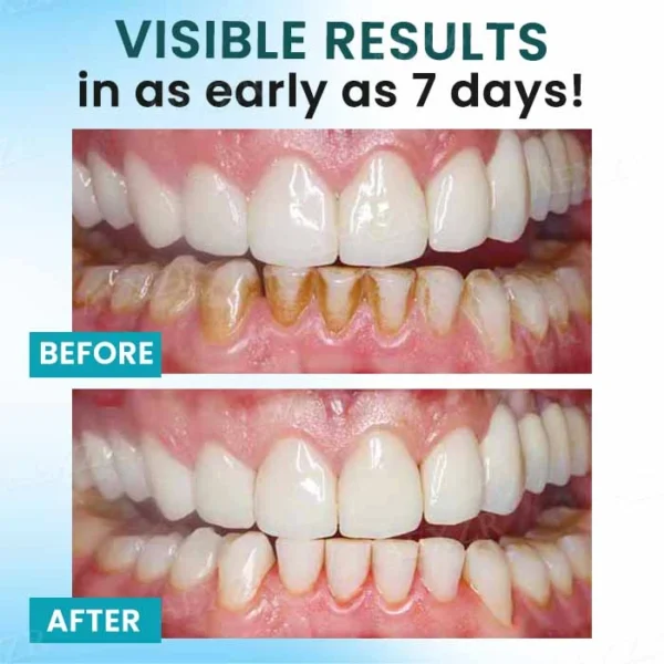 AEXZR® Oral Calculus Suppressant