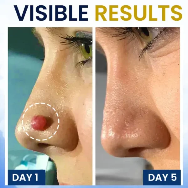 AEXZR® Skin Tag Cryo Treatment Spray