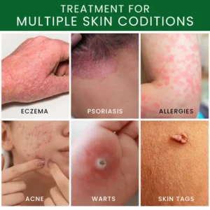 AEXZR® Tea Tree Oil Skin Treatment Cream