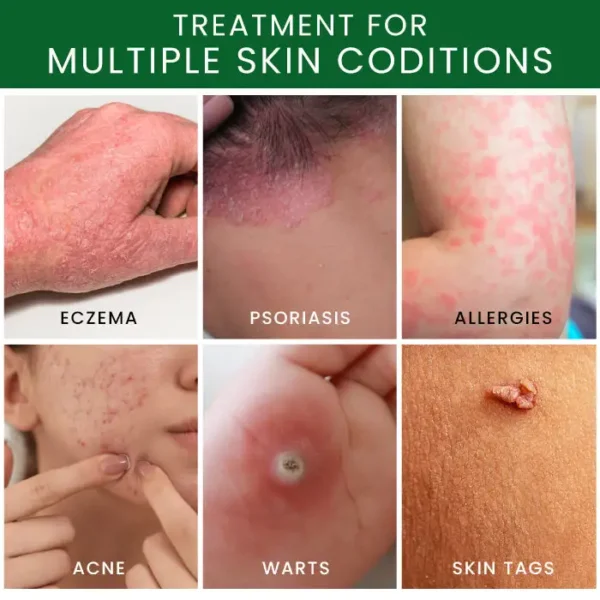 AEXZR® Tea Tree Oil Skin Treatment Cream