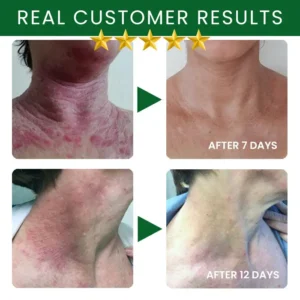AEXZR® Tea Tree Oil Skin Treatment Cream