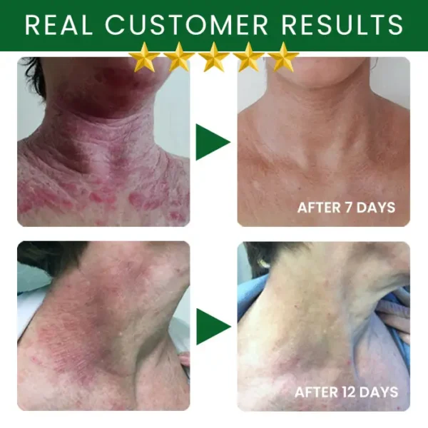 AEXZR® Tea Tree Oil Skin Treatment Cream