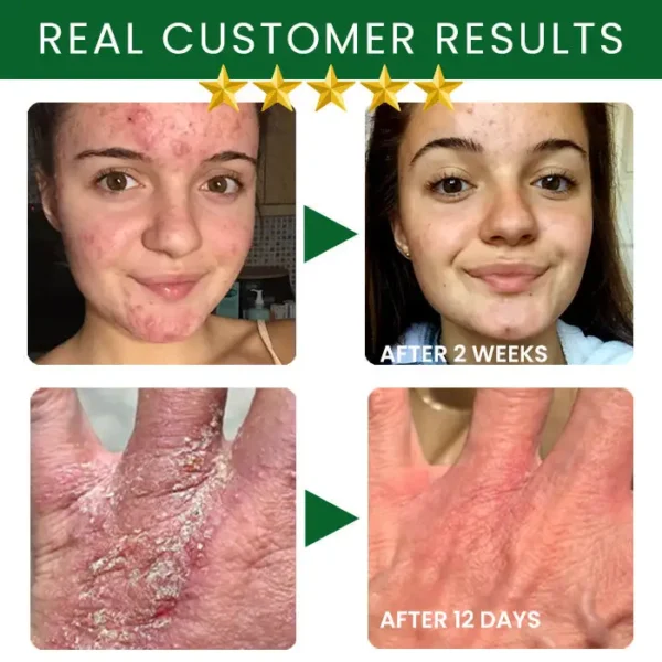 AEXZR® Tea Tree Oil Skin Treatment Cream
