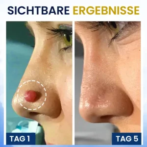 AEXZR® Hautanhängsel-Kryo-Behandlungsspray