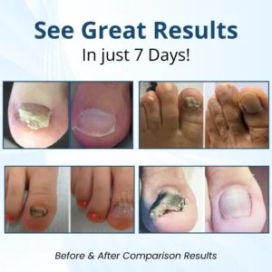 AEXZR® MycoShield Pro Fungal Nail Patches
