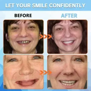 ROSOPL™ Adhesive teeth (upper and lower)